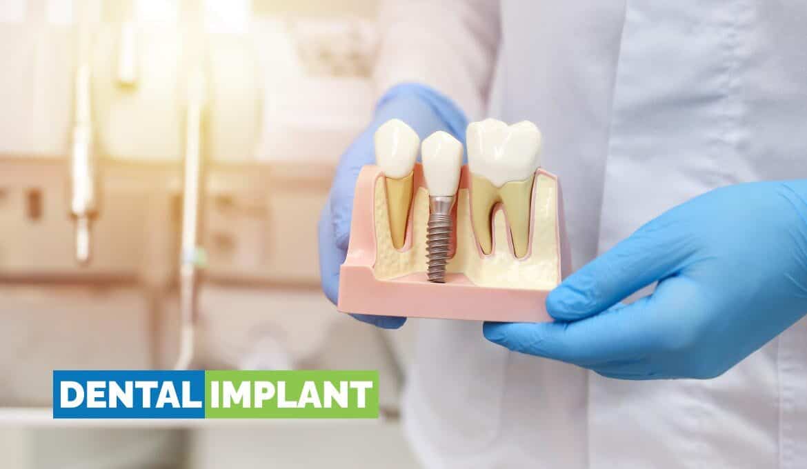 Dental Implants