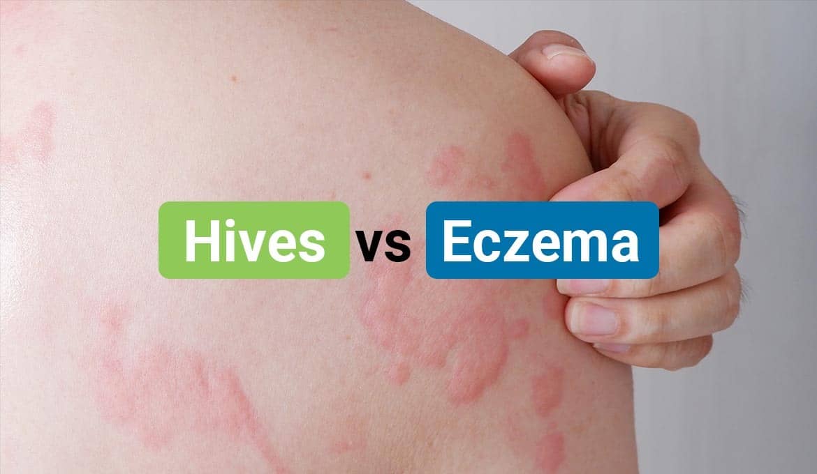 Hives vs Eczema