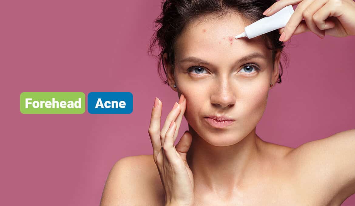 how to get rid of forehead acne