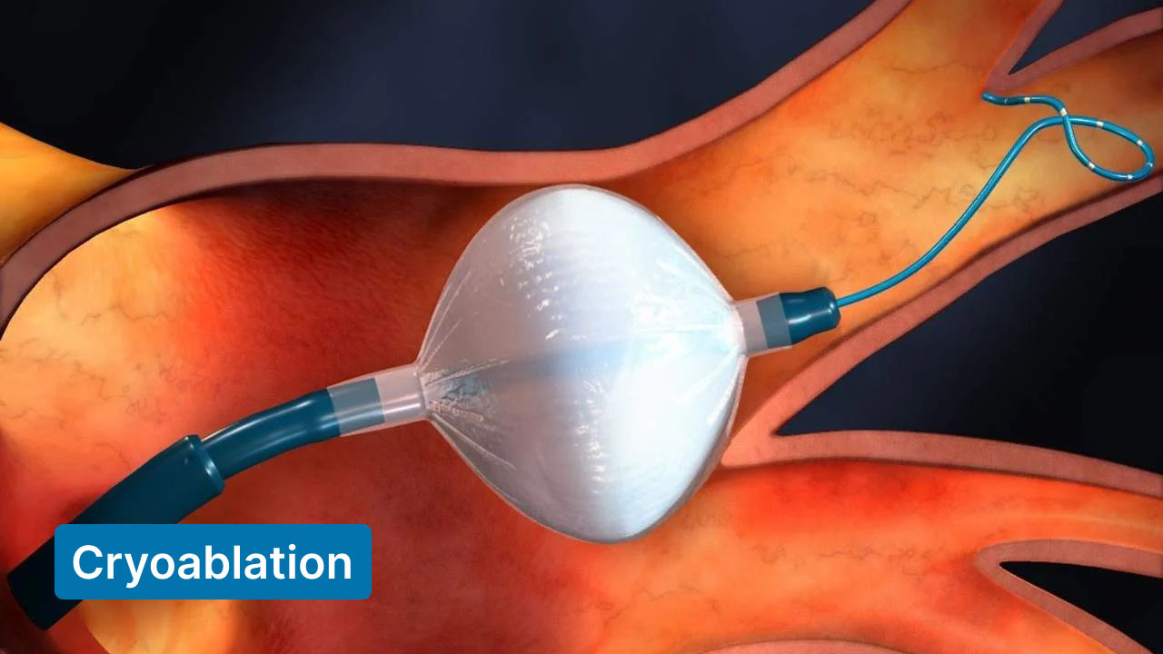 cryoablation