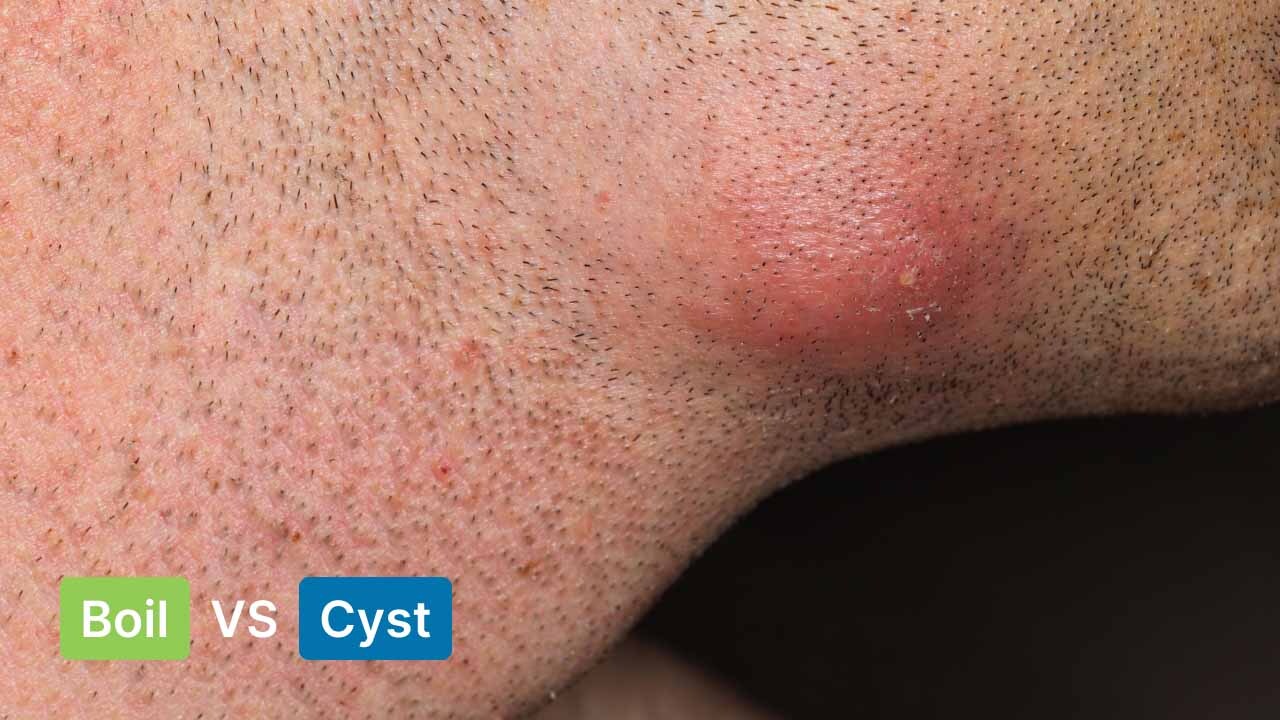 Boil Vs Cyst