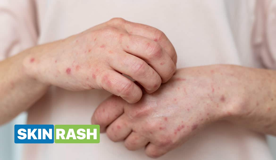 Skin Rash