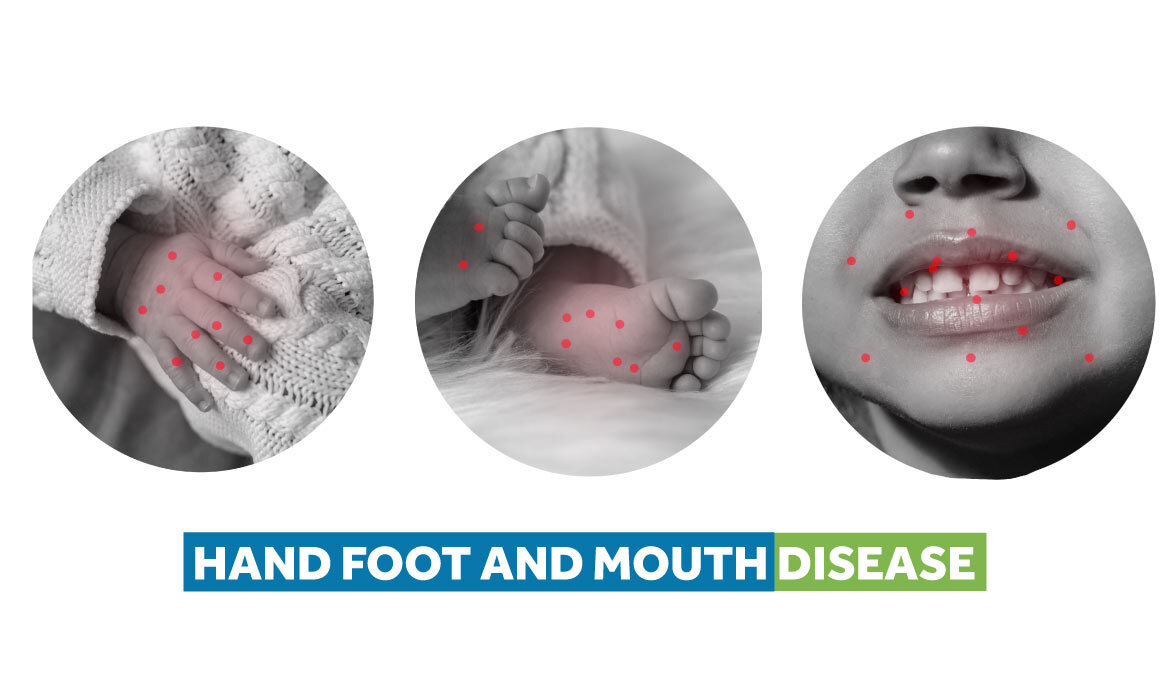 Hand Foot And Mouth Disease